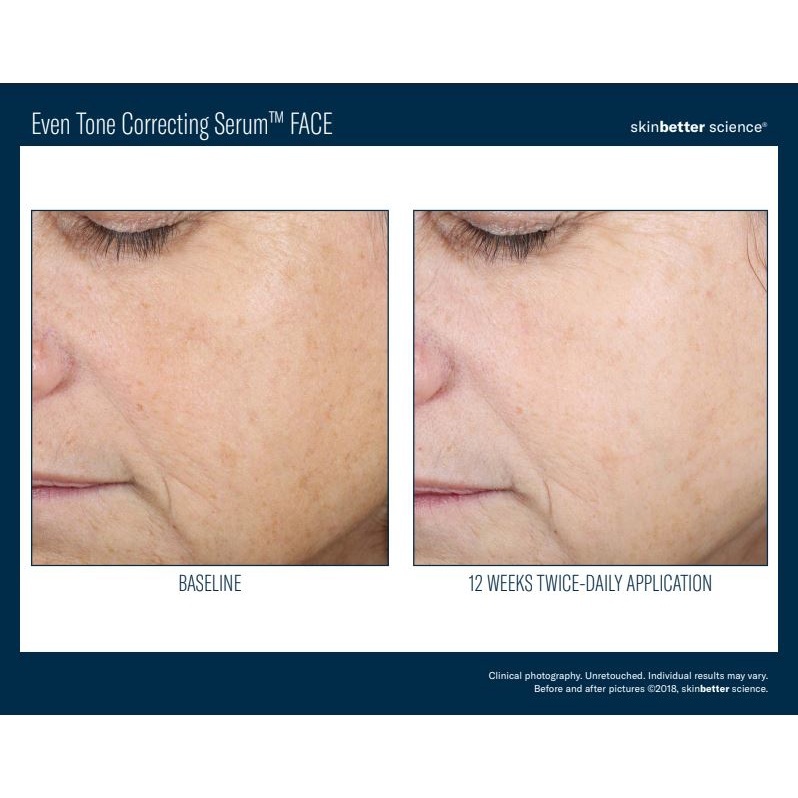 Serum Skinbetter Even Tone Correcting 50ml Giảm Nám, Tàn Nhang, Sáng Da