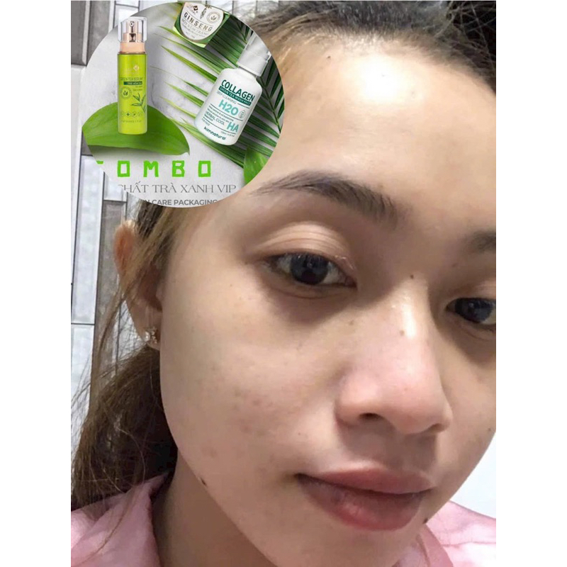 COMBO TINH CHẤT TRÀ XANH VIP KIMNATURAL MẪU MỚI