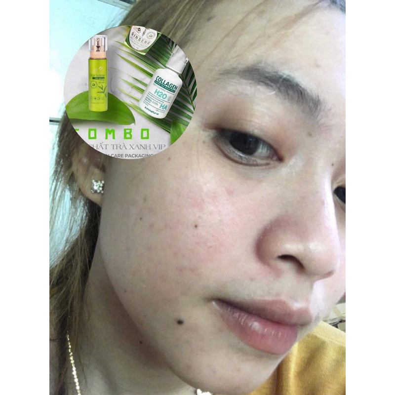 COMBO TINH CHẤT TRÀ XANH VIP KIMNATURAL MẪU MỚI