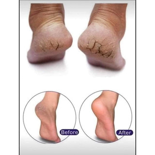 Kem Dưỡng Gót Chân Scholl Schrunden Salbe 25% Urea – Hỗ Trợ Chăm Sóc Da Chân Khô