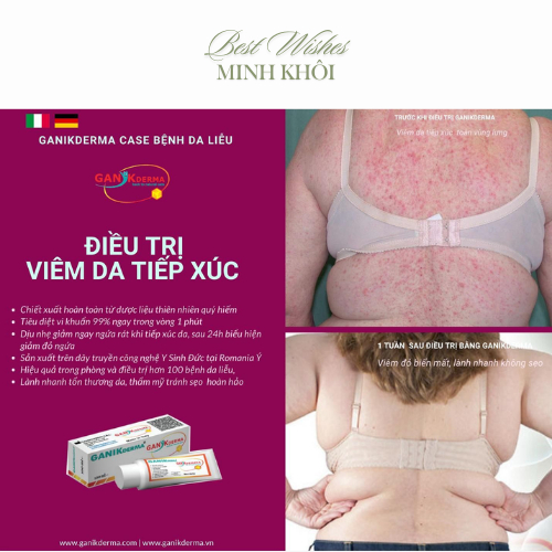 Kem phục hồi vết thương GANIKderma 20ml làm đầy sẹo lõm, sẹo rỗ hạn chế phát triển sẹo lồi.
