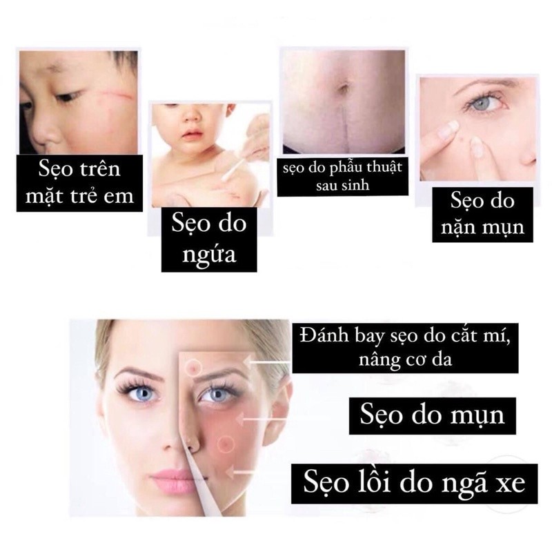 T0P 1 Kem sẹo bán chạy nkất Tây Ban Nha - Kem tr! sẹo lồi, lõm, tăng sắc tố ISDIN Cicapost Cream 50g