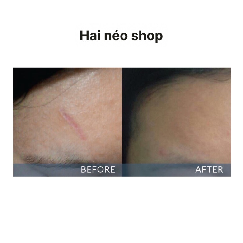 T0P 1 Kem sẹo bán chạy nkất Tây Ban Nha - Kem tr! sẹo lồi, lõm, tăng sắc tố ISDIN Cicapost Cream 50g