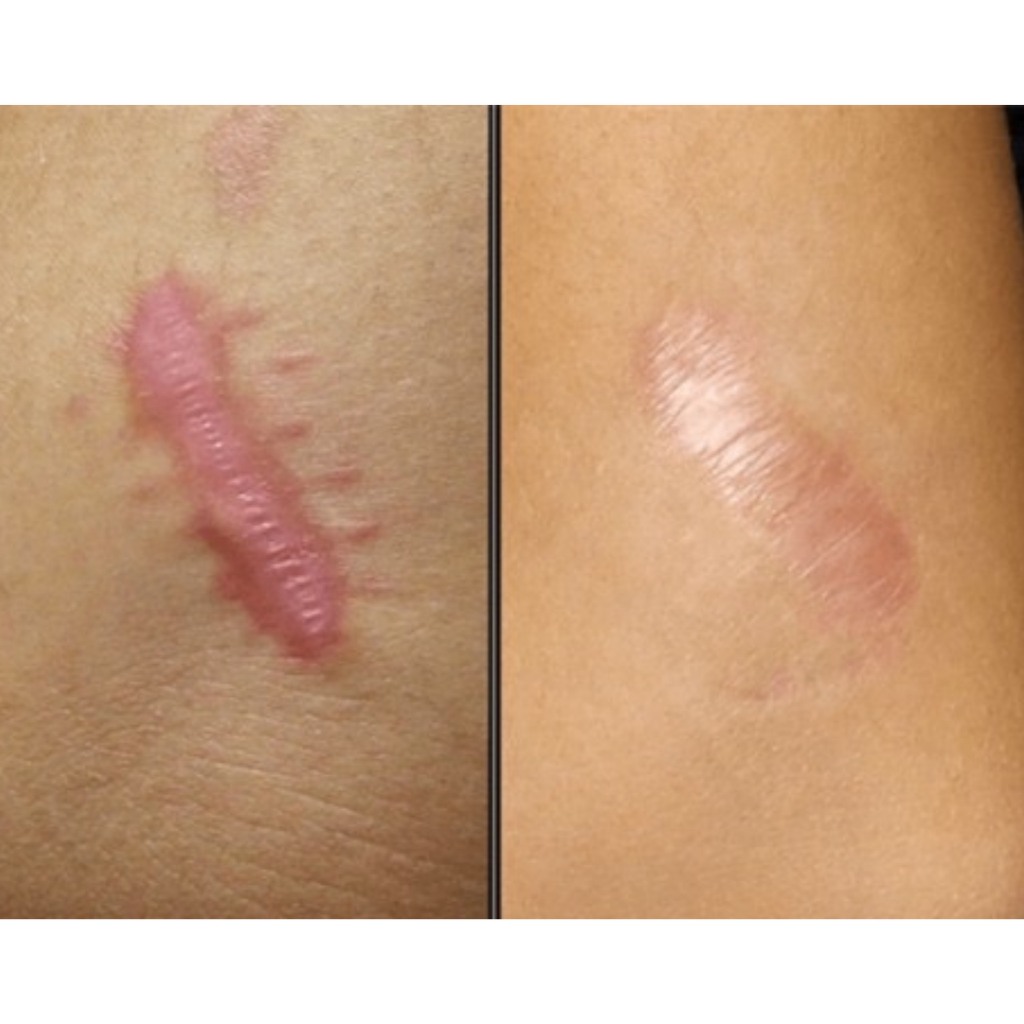 T0P 1 Kem sẹo bán chạy nkất Tây Ban Nha - Kem tr! sẹo lồi, lõm, tăng sắc tố ISDIN Cicapost Cream 50g