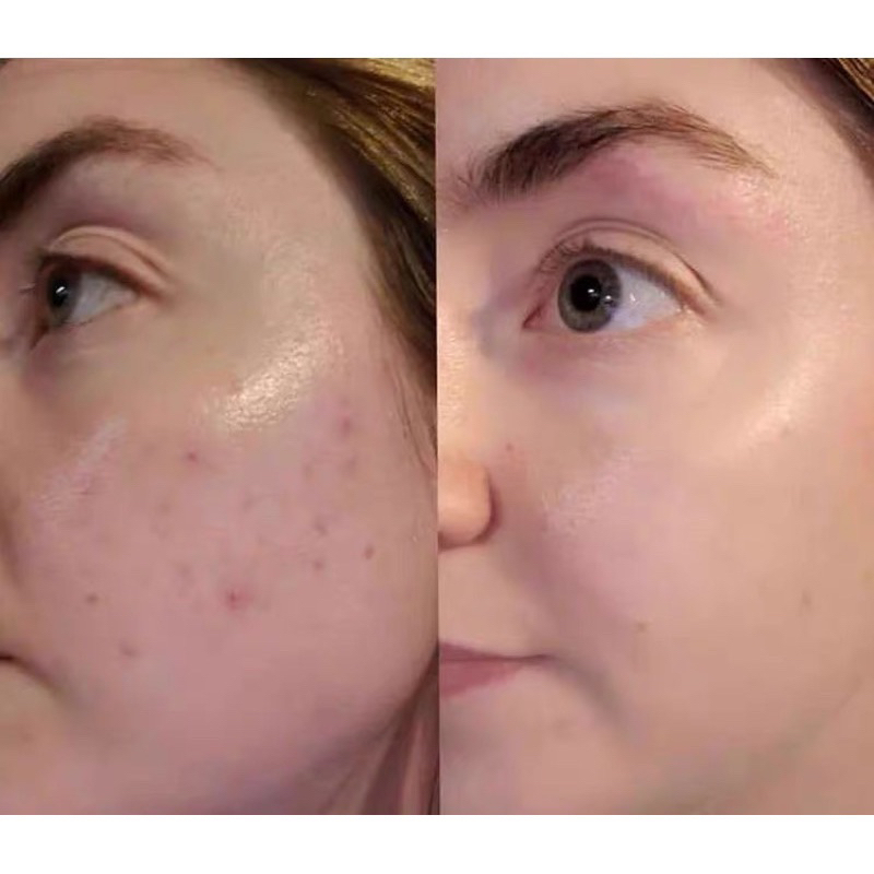 Chấm mụn Kate Sommerville Eradikate Acne Spot Treatment 30ml