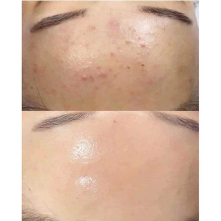( 15ml) Kem Chấm Mụn - BIOTRADE ACNAUT ACTIVE CREAM