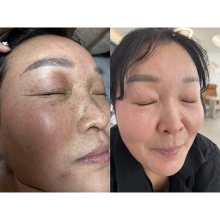 Chấm tàn nhang, nốt ruồi, mụn thịt, mụn cóc - Handmade