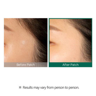 Miếng Dán SOME BY MI 30 Days Miracle Trong Suốt [18 miếng dán/gói]