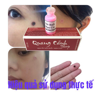 Tẩy nốt ruồi ,tàn nhang , mục cóc, mắt cá , mụn thịt handmade