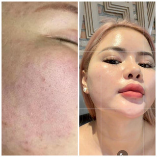 Tinh chất bạch ngọc Devacell- Tinh chất bộ phân huỷ nám Deva  Cell