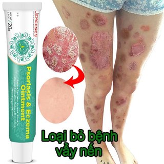 Thảo dược kháng khuẩn kem vẩy nến chống ngứa eczema phát ban nổi mề đay làm sạch