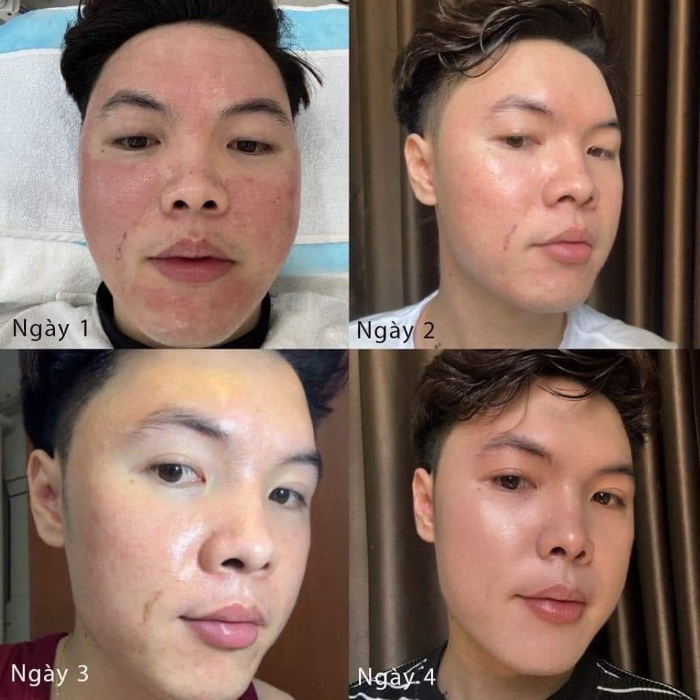 Huyết tương phục hồi da Evenswiss Regenerating Plasma 30-50-100ML