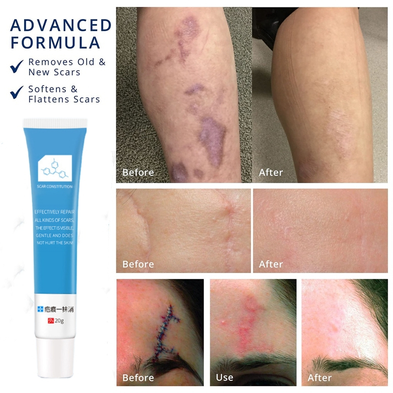 Scar Cream Scar Removal Kem sẹo sẹo lồi Loại bỏ sẹo Vết rạn da Làm mịn da Sửa chữa vết thương Vết sẹo phẫu thuật