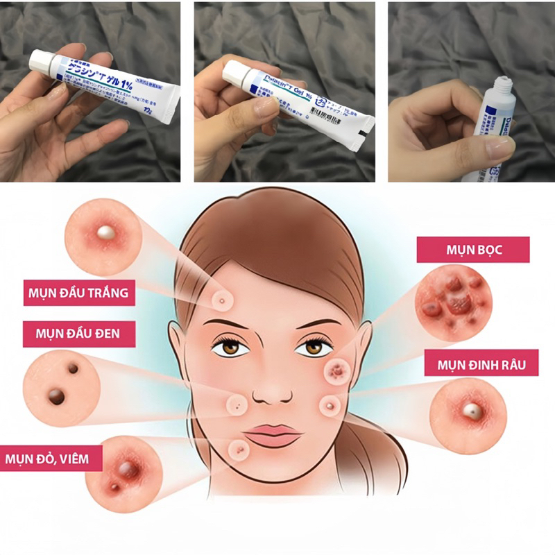 Kem giảm mụn Dalacin T Gel 1%