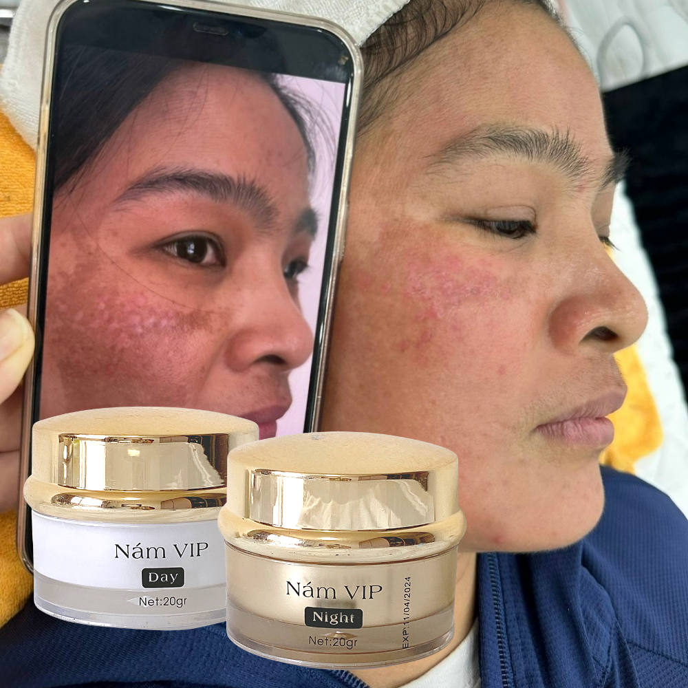 GÍA SỈ TẠI XƯỞNG  Cặp Đôi Kem Nám Da Ban Ngày và Ban Đêm, Dưỡng trắng da