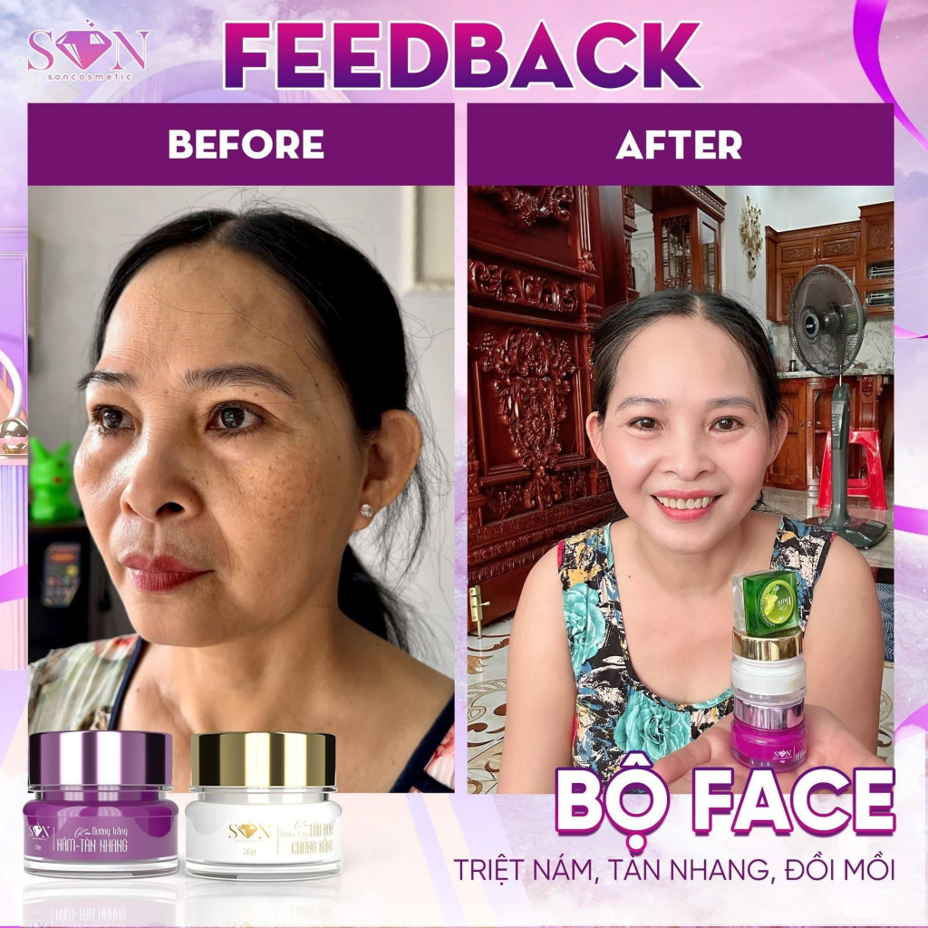 Combo 2 SP Kem Face Nám Ngày Đêm SON Tiên Nguyễn Tặng Cao Bưởi