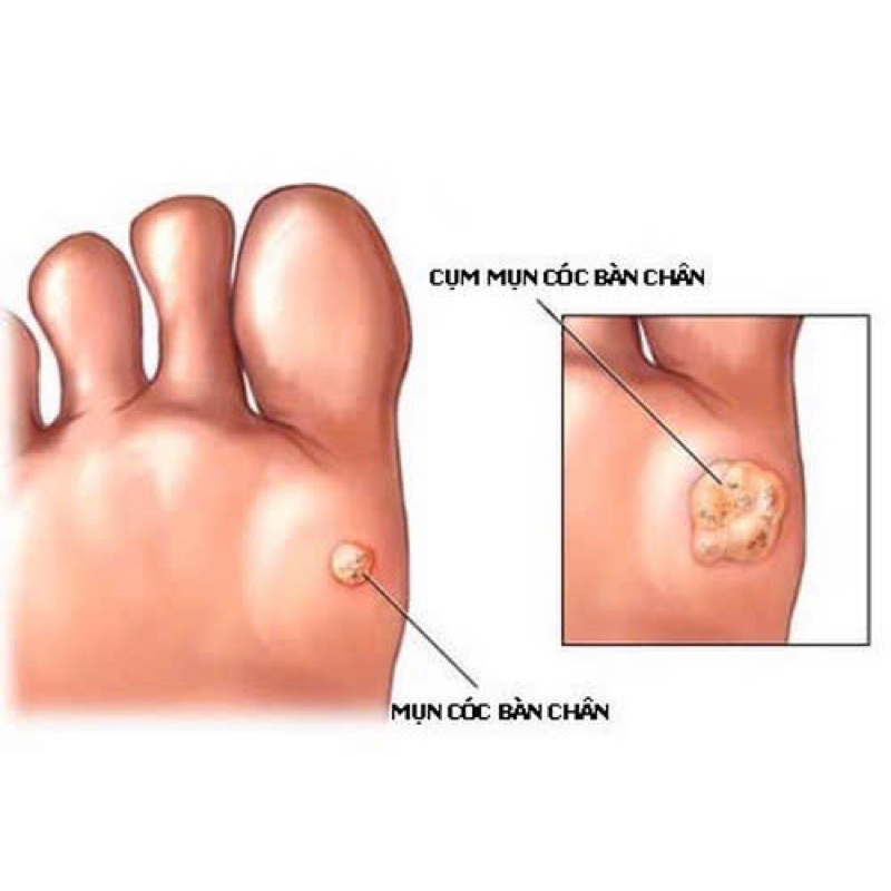 🇩🇪Guttaplast - Miếng dán lột da chai/ mụ t Có c