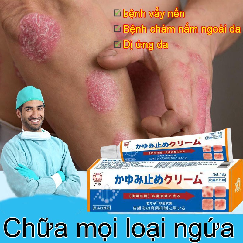 Kem bôi nấm ngứa Kem bôi vẩy nến Hắc lào vảy nến mề đay ngứa nấm lang ben kem bôi ngứa viêm da