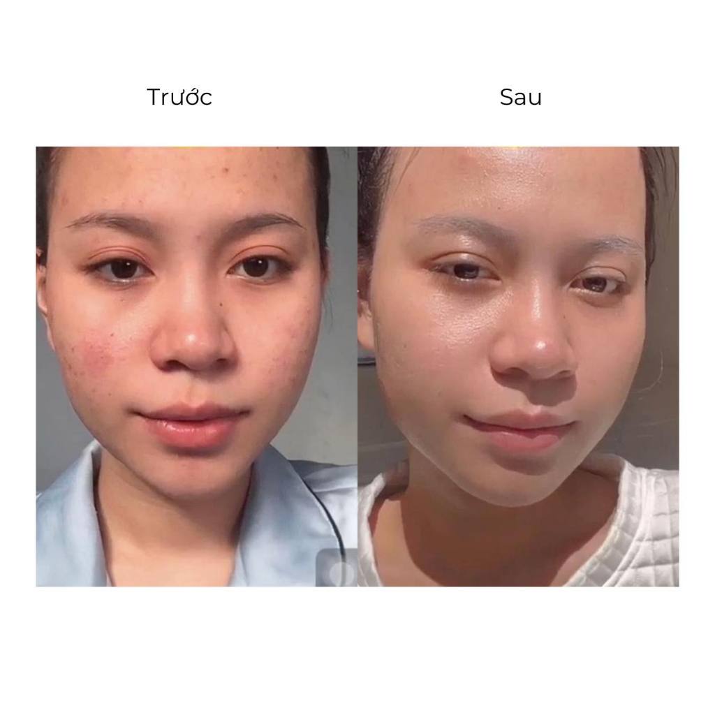 Tinh chất The Auragins 10% Niacinamide + 1% Zinc Acne Clear Brightening Serum 30ml