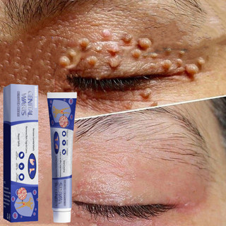 Kem xoá mụn cóc 20g,mụn thịt,loại bỏ mụn cóc thông thường,mụn đá,mụn cơm,mụn cóc dạng sợi