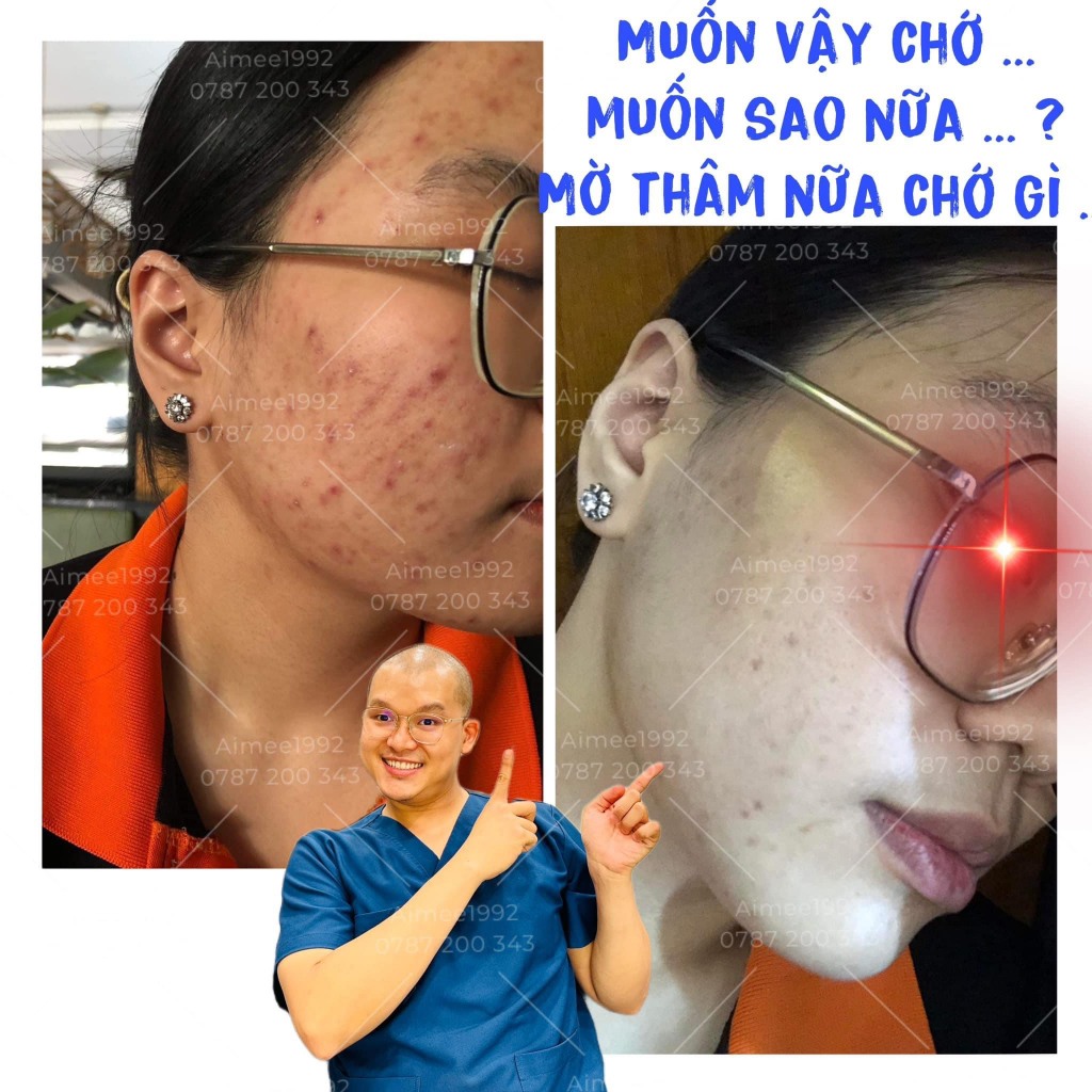 Serum Chăm Sóc Da Mụn, Mờ Thâm Lucin LURCINN SAPANZI Prevent Acne 10ml