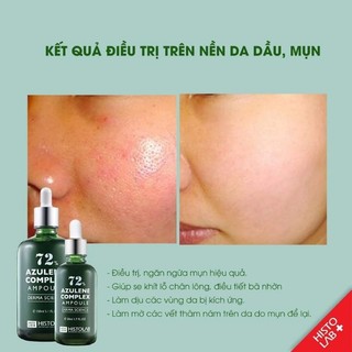 TINH CHẤT  AZULENE COMPLEX AMPOULE 72%