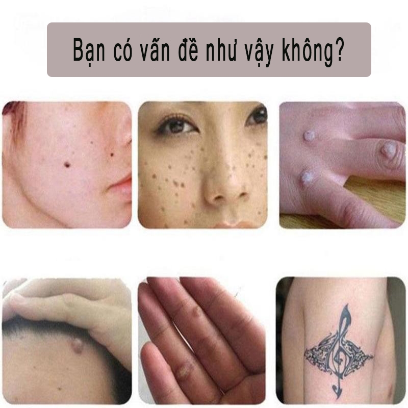tẩy nốt ruồi chấm nốt ruồi Loại Bỏ Vết Đốm Đốm Đen Tàn Nhang loại bỏ mụn cóc ở da,Độ Làm Đẹp Da phục hồi da và làm sạch