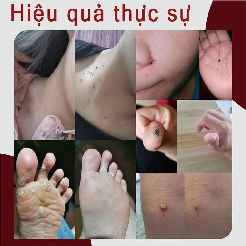 tẩy nốt ruồi chấm nốt ruồi Loại Bỏ Vết Đốm Đốm Đen Tàn Nhang loại bỏ mụn cóc ở da,Độ Làm Đẹp Da phục hồi da và làm sạch