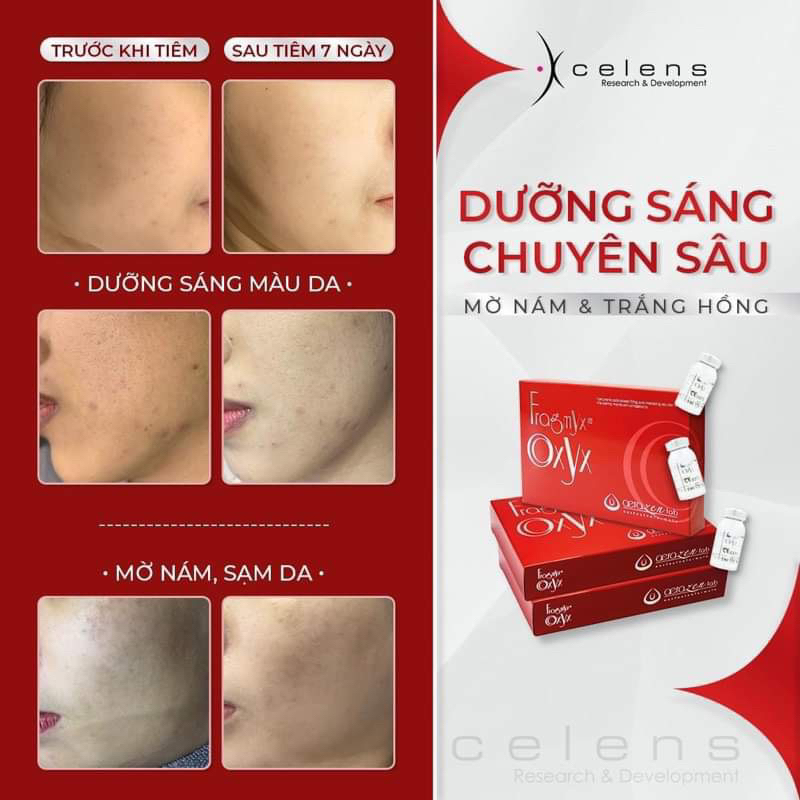 Mesotherapy Fragmyx OxYx XCELENS Trắng Da Mờ Thâm Nám Chống Lão Hóa