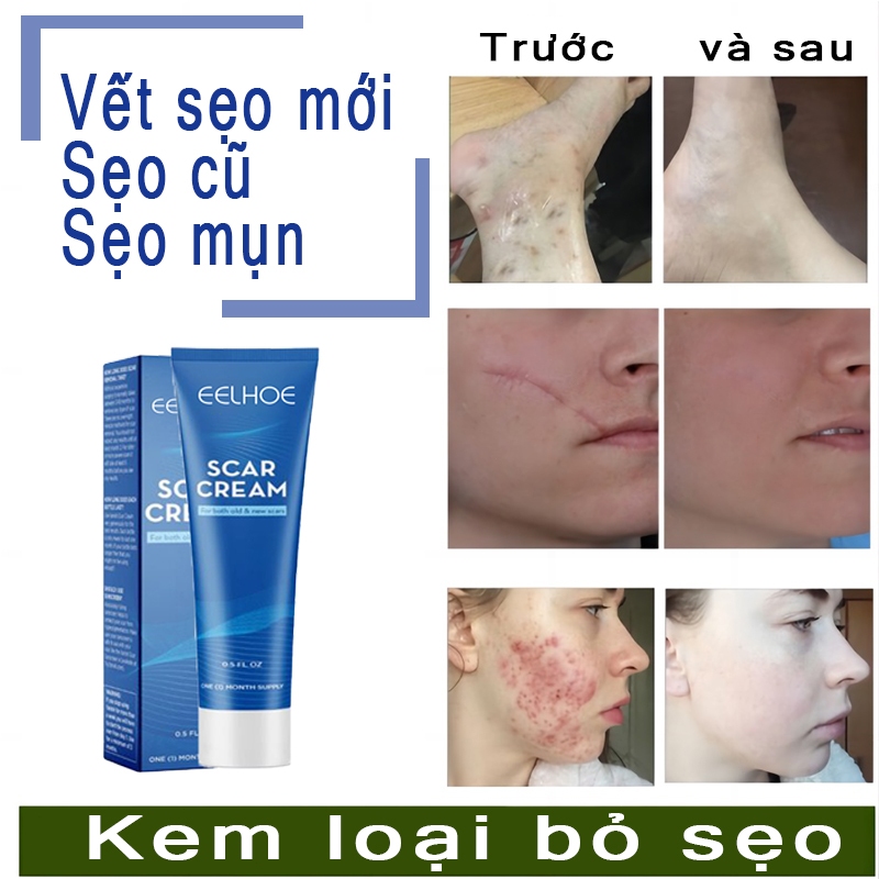 Kem Làm Mờ Phẳng Sẹo Lồi Lõm EELHOE Scar Cream - Kem EELHOE Mờ Thâm Sẹo Cứng Lâu Năm Do Mụn, Rạn Thúc Đẩy Phục Hồi