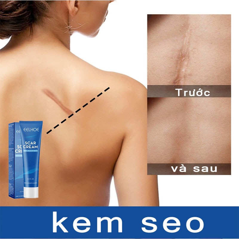 Kem Làm Mờ Phẳng Sẹo Lồi Lõm EELHOE Scar Cream - Kem EELHOE Mờ Thâm Sẹo Cứng Lâu Năm Do Mụn, Rạn Thúc Đẩy Phục Hồi