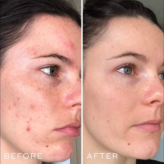 Serum phục hồi cấp ẩm B5 Medik8