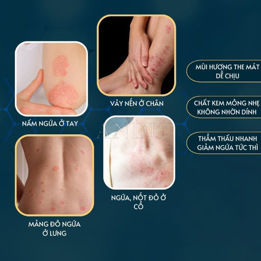 Kem Bôi Nấm Ngứa Viêm Da Cơ Địa Hắc Lào, Vẩy Nến, Á Sừng, Lang Ben Hiệu Quả - BÀ LÃO XANH