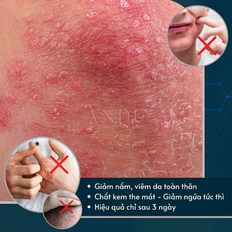 Kem Bôi Nấm Ngứa Viêm Da Cơ Địa Hắc Lào, Vẩy Nến, Á Sừng, Lang Ben Hiệu Quả - BÀ LÃO XANH