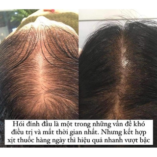 Xịt mọc tóc Minoxidil Bailleul 2% 5%
