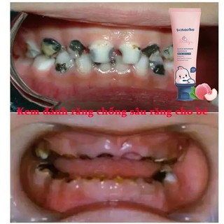 Kem đánh răng trẻ em kem đánh răng cho bé kem đánh răng trắng răng ngăn ngừa sâu răng làm trắng răng loại bỏ vết ố vàng