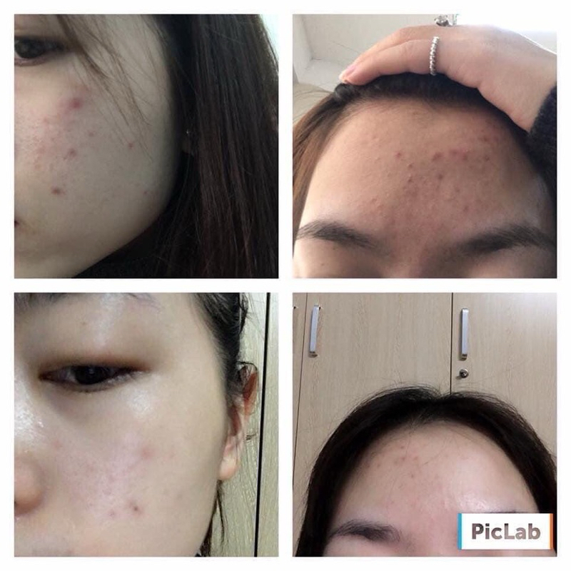 Kem Giảm Mụn Ngừa Thâm La Roche Posay Effaclar Duo+