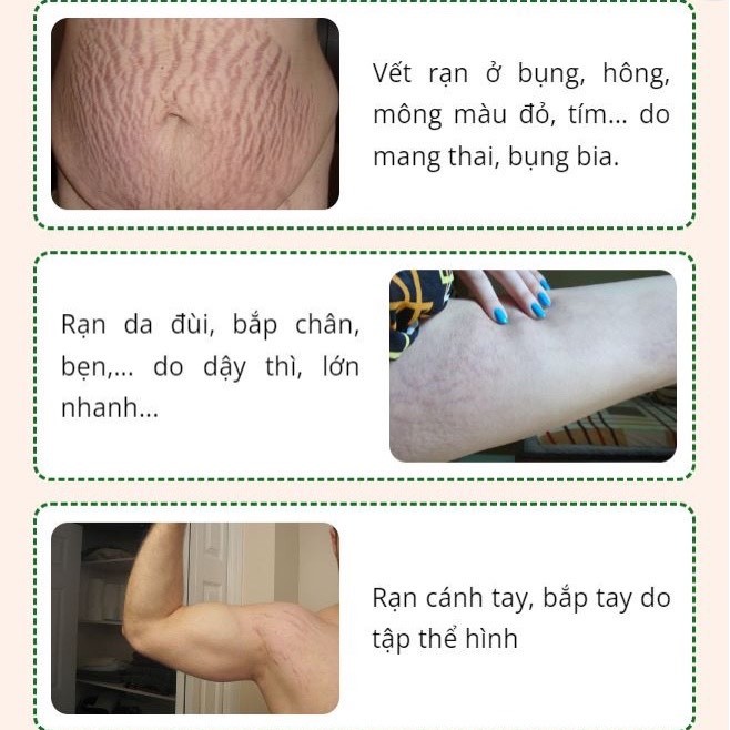 [Date 12 tháng sau khui seal - nội địa Đức] Gel đặc tr! rạn da, mờ sẹo, thâm sần chiết xuất dịch ốc sên KRÄUTERHOF Snail