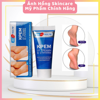 Kem Ngăn Ngừa Và Hồi Phục Nứt Nẻ Gót Chân Kpem Nga 50ml