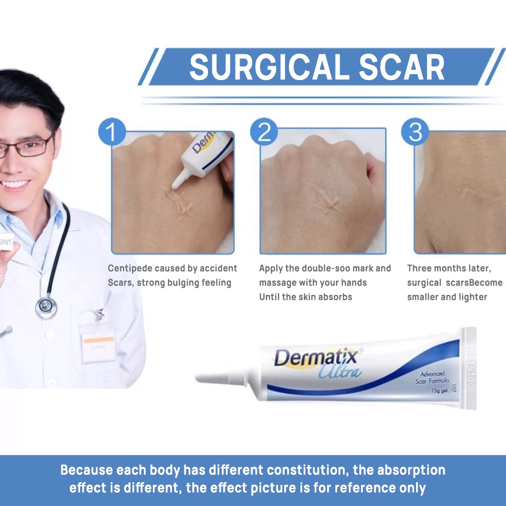 Dermatix Ultra Kem sẹo 15g/Dermatix Ultra Gel Làm Mờ Sẹo