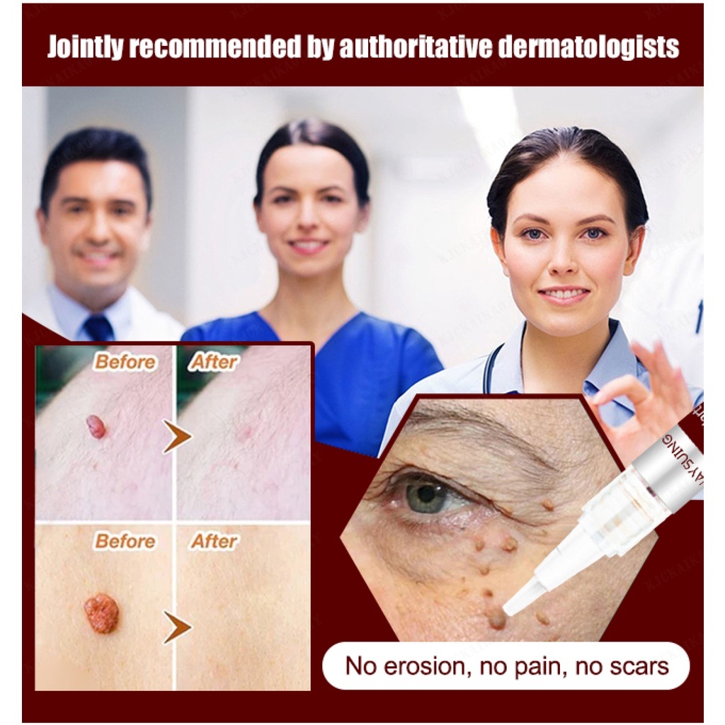 Bút Chấm Mụn Thịt, Tẩy Nốt Ruồi, Xóa Tàn Nhang, thành phần thảo dược 100% an toàn và không đau rát