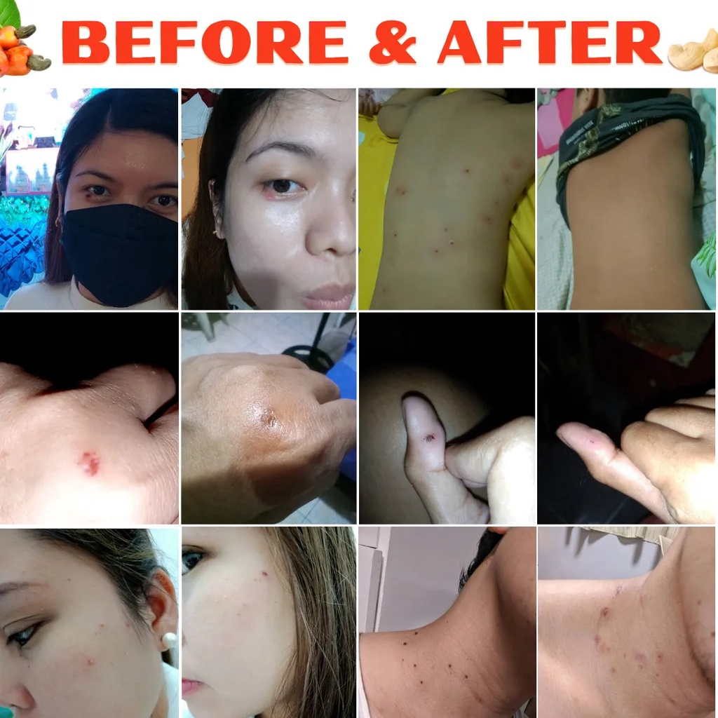 Bút Chấm Mụn Thịt, Tẩy Nốt Ruồi, Xóa Tàn Nhang, thành phần thảo dược 100% an toàn và không đau rát