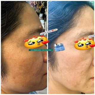 Kem She Peeling Tái Tạo Da