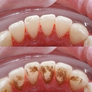 KEM ĐÁNH TRẮNG RĂNG EUCRYL TOOTHPASTE
