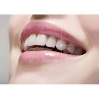 30 viên đá đính răng tự gắn tại nhà