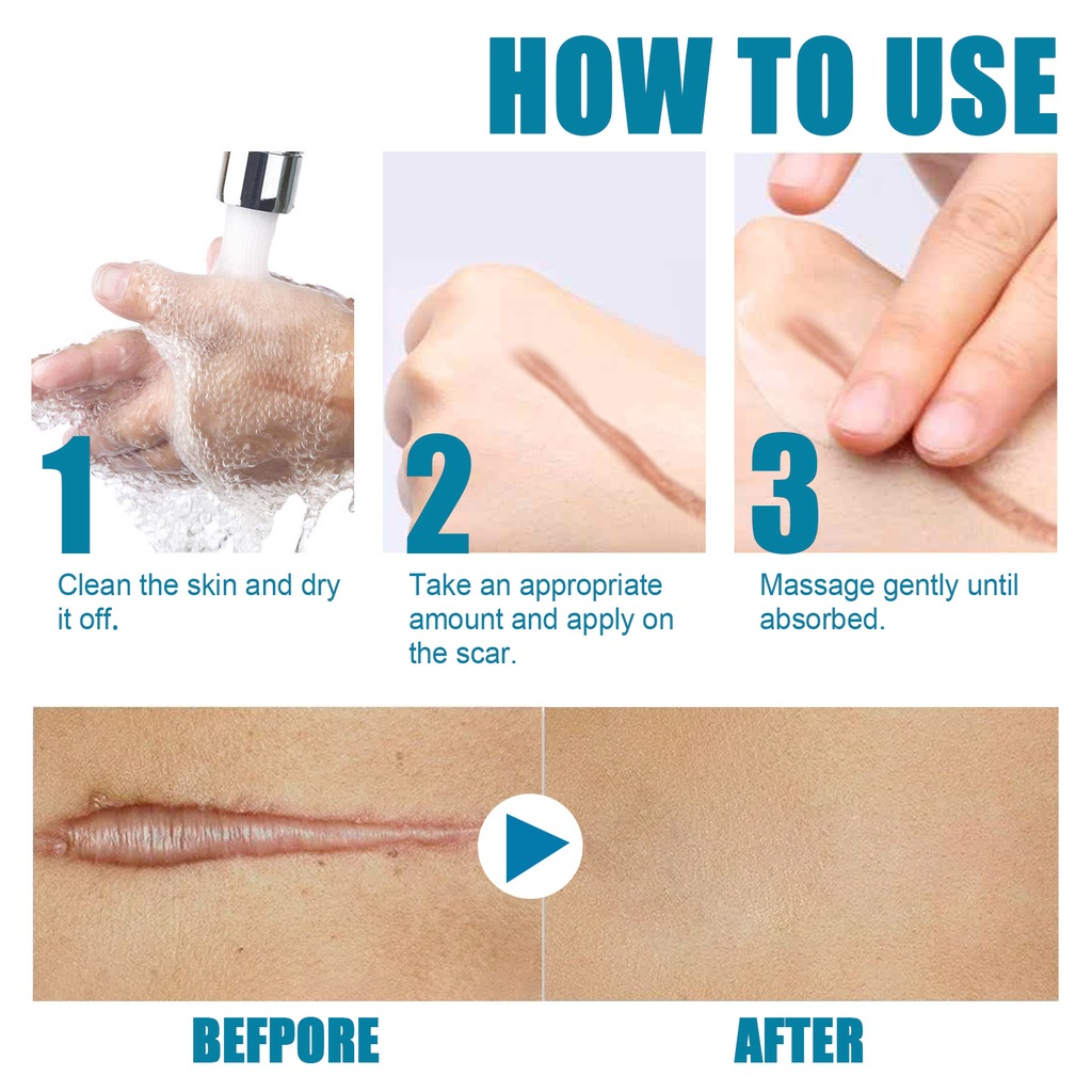 Scar Cream Scar Removal Kem sẹo sẹo lồi Loại bỏ sẹo Vết rạn da Làm mịn da Sửa chữa vết thương Vết sẹo phẫu thuật