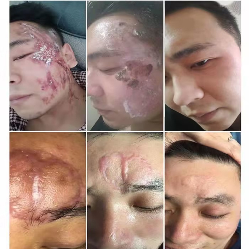 Gel bôi sẹo Kem bôi sẹo Loại bỏ các vết sẹo cũ Vết rạn Sẹo phẫu thuật Loại bỏ tận gốc các loại sẹo