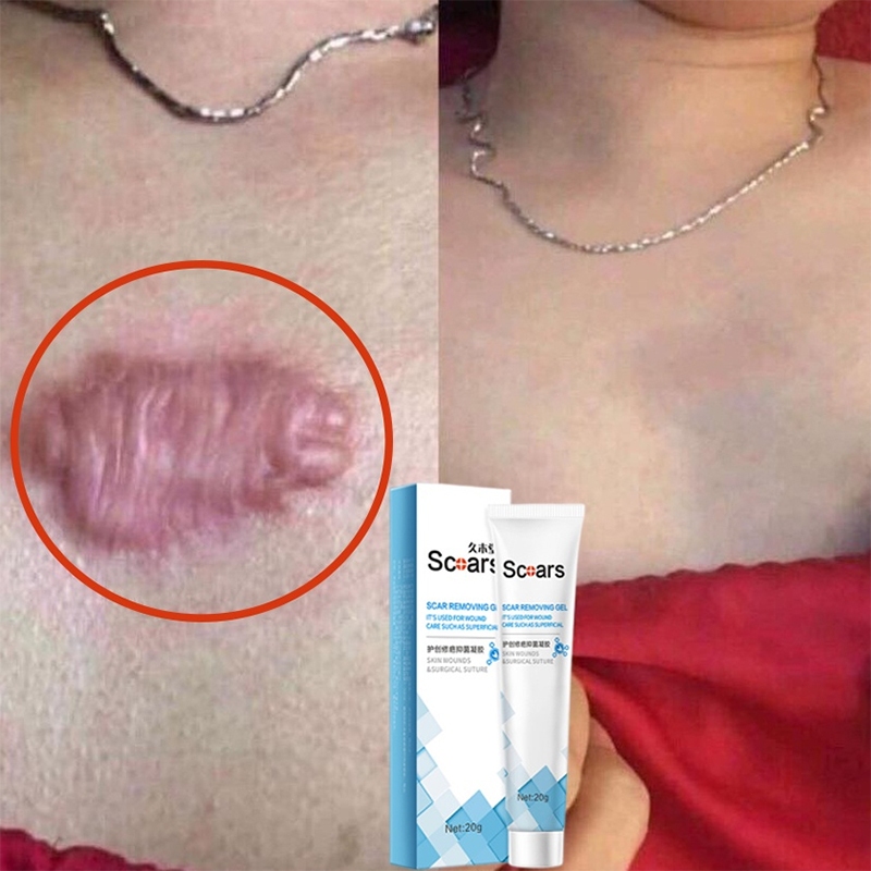 Gel bôi sẹo Kem bôi sẹo Loại bỏ các vết sẹo cũ Vết rạn Sẹo phẫu thuật Loại bỏ tận gốc các loại sẹo