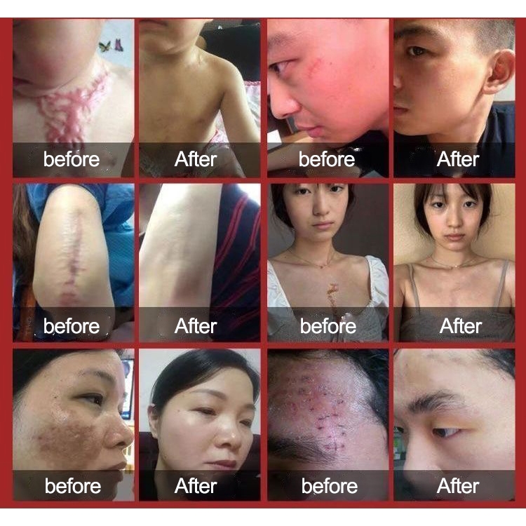 Gel bôi sẹo Kem bôi sẹo Loại bỏ các vết sẹo cũ Vết rạn Sẹo phẫu thuật Loại bỏ tận gốc các loại sẹo