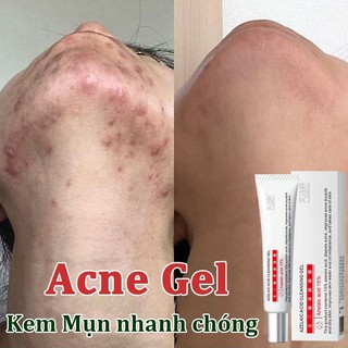 Kem mụn kem chấm mụn chấm mụn acnes,gel chấm mụn,kem bôi mụn chấm mụn